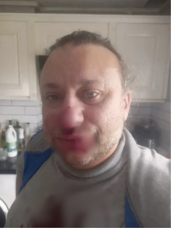 tv100’de yer alan habere göre, Onur Akay’ın uğradığı köpek saldırısının ardından vücuduna bakterilerin bulaştığı ve bunun ciddi bir enfeksiyona yol açtığı belirtildi.