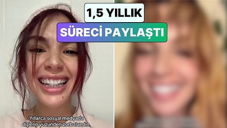 Bir İçerik Üreticisi Plak Tedavisiyle 1.5 Yılda Yaşadığı Değişimi Paylaştı