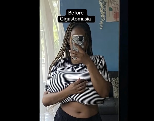 So, what does gigantomastia mean?