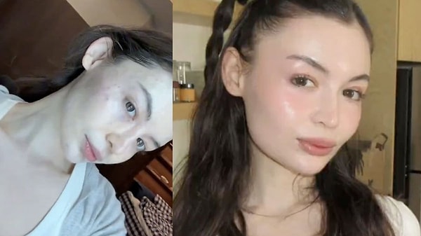 Kore'ye giden içerik üreticisi Meryem Can, yüzüne somon spermi enjeksiyonu yaptırdıktan sonra yaşadıklarını anlattı.