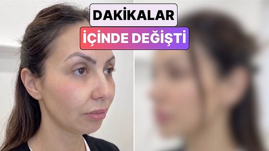 Yüzünün Beş Farklı Bölgesine Dolgu Yaptıran Kadının Değişimi Viral Oldu