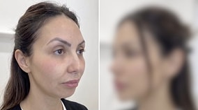 Transformation of Woman Who Had Fillers in Five Different Areas of Her Face Goes Viral