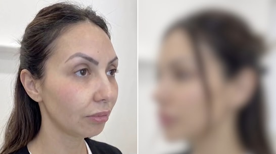 Transformation of Woman Who Had Fillers in Five Different Areas of Her Face Goes Viral