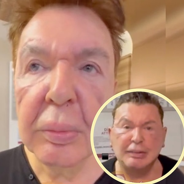 "Kuşum Aydın" lakabıyla tanınan sanatçı Aydın Uğurlular, yıllar önce yaptırdığı hatalı dolgular nedeniyle yüzünde oluşan ciddi deformasyonları gidermek amacıyla yüz gerdirme ameliyatı olmuştu.