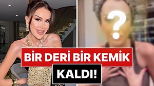 Bir Deri Bir Kemik Kalan Dilan Polat'ın Son Hali Endişelendirdi!