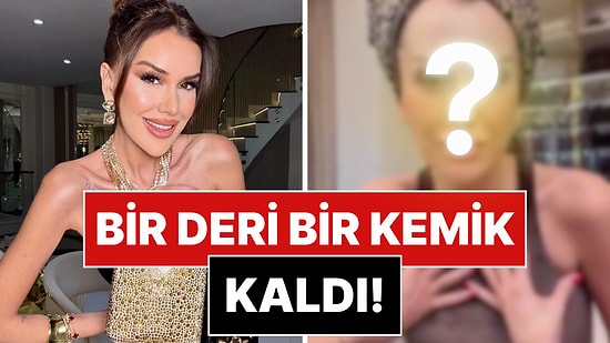 Bir Deri Bir Kemik Kalan Dilan Polat'ın Son Hali Endişelendirdi!