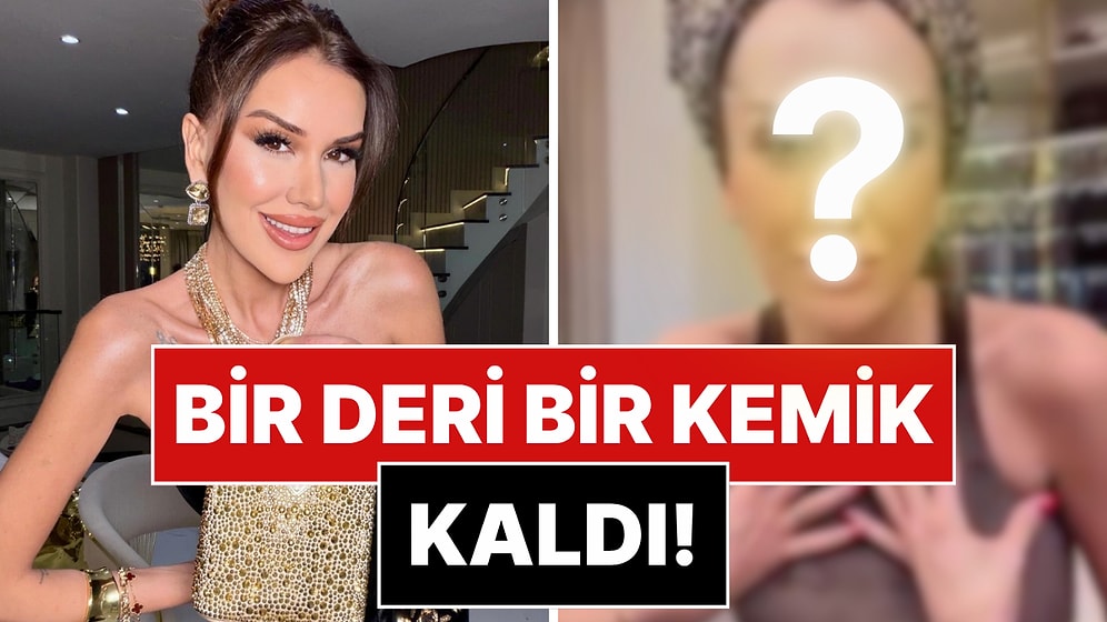 Bir Deri Bir Kemik Kalan Dilan Polat'ın Son Hali Endişelendirdi!