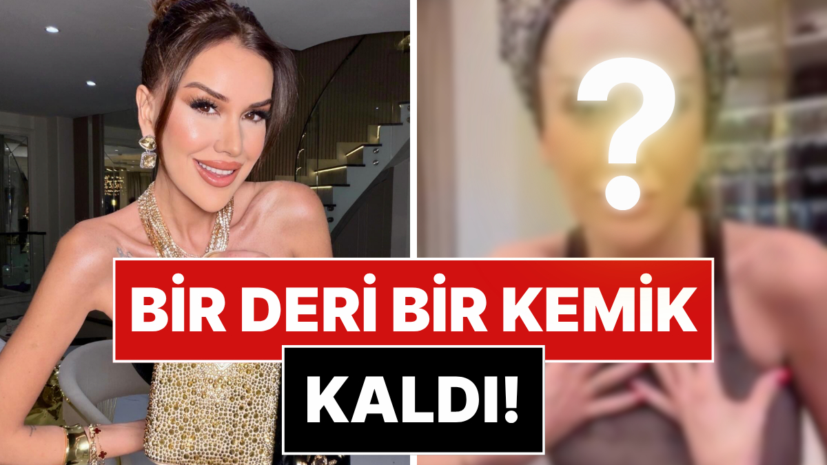 Bir Deri Bir Kemik Kalan Dilan Polat'ın Son Hali Endişelendirdi!