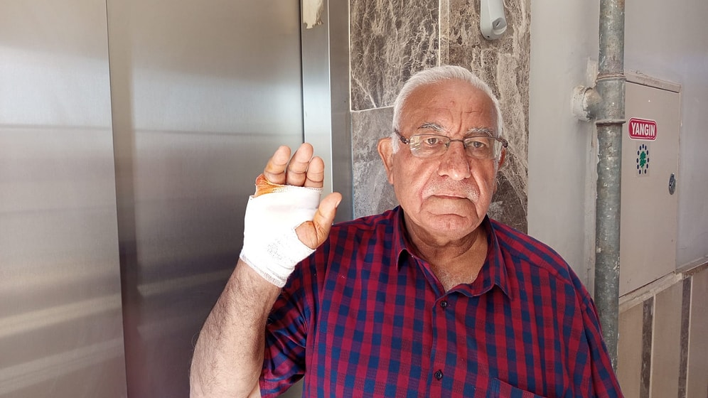 No Prior Hostility: Man Bites off and Severs Neighbor's Finger During Unexpected Fight