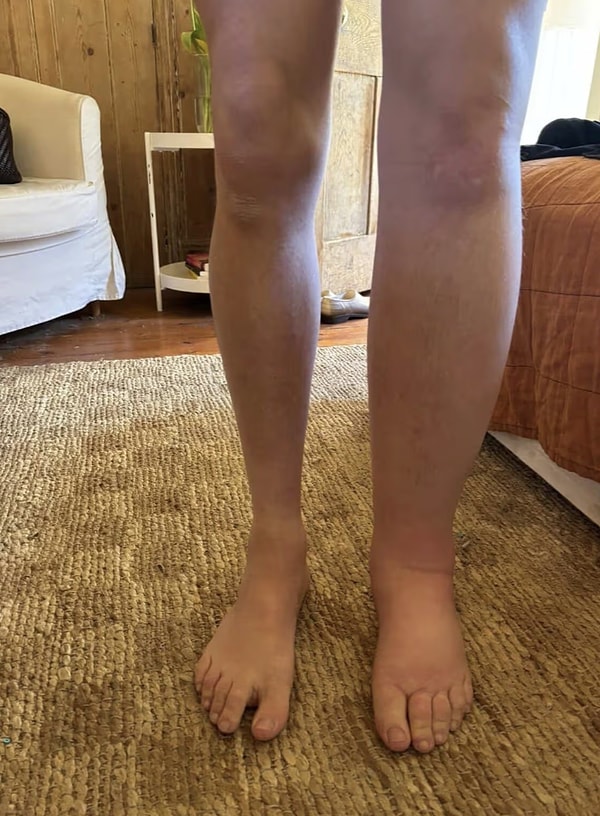 For Sam, who is currently compelled to continually wrap his leg in compression bandages, thus limiting his mobility, his family has initiated a fundraising campaign.