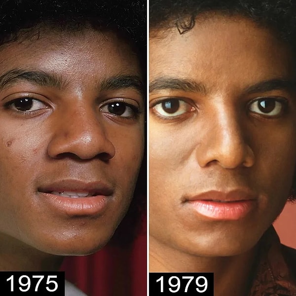 Michael Jackson'un burnunun yıllar içindeki değişimini şöyle bırakalım👇🏻