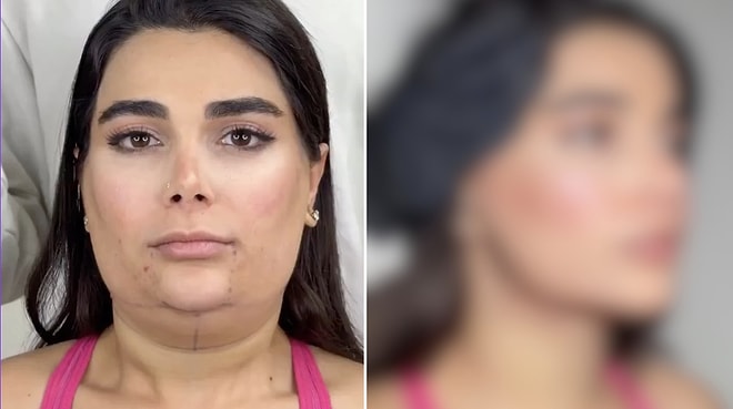 Woman's Transformation After Face and Neck Lift Surgery Receives Great Praise