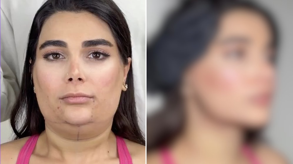 Woman's Transformation After Face and Neck Lift Surgery Receives Great Praise