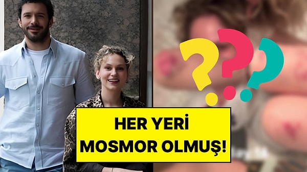 Soy Filminin Çekimlerine Başlamıştı: Farah Zeynep Abdullah Vücudundaki Morlukları Paylaştı