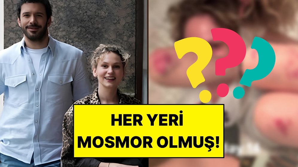 Soy Filminin Çekimlerine Başlamıştı: Farah Zeynep Abdullah Vücudundaki Morlukları Paylaştı