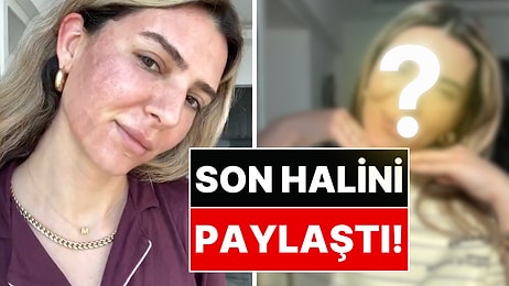 Yüzüne Fraksiyonel Lazer Yaptıran Survivor Yarışmacısı Merve Aydın Son Halini Paylaştı