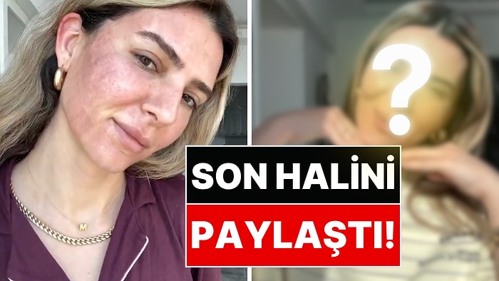 Yüzüne Fraksiyonel Lazer Yaptıran Survivor Yarışmacısı Merve Aydın Son Halini Paylaştı