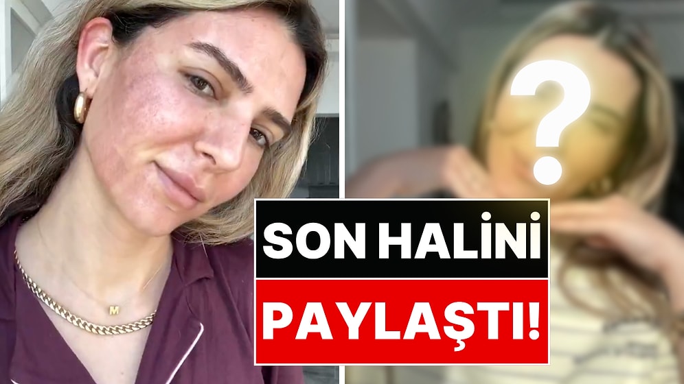 Yüzüne Fraksiyonel Lazer Yaptıran Survivor Yarışmacısı Merve Aydın Son Halini Paylaştı