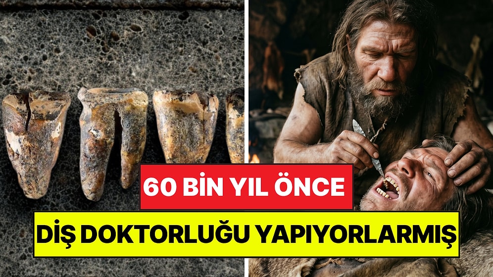 60 Bin Yıl Önce Diş Doktorluğu Yapıyorlarmış: Neandertaller Diş Çürüğünü Taşla Tedavi Etmiş