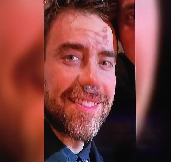 Fakat tüm bunların yanında Murat Dalkılıç’ın magazin tarihine geçen en büyük meselesi hiç kuşkusuz bitmek bilmeyen burun ameliyatları!