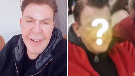 Kuşum Aydın’s Filter-Free “Real” Look Revealed After Facelift Surgery!