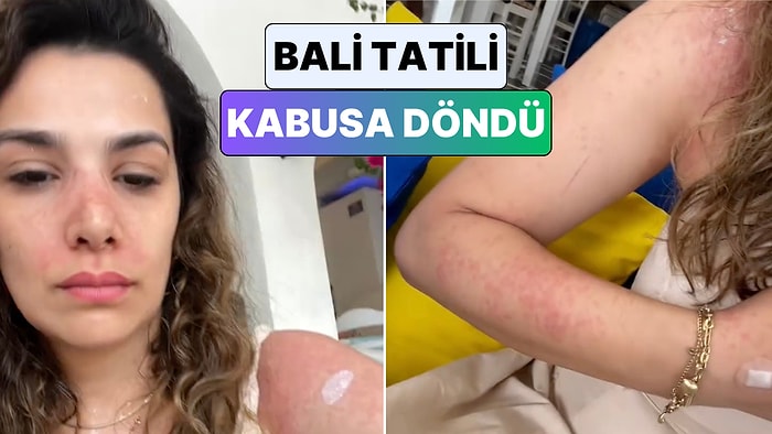 Bali'de Kirli Sudan Mikrop Kapan Genç Kadın Ülkedeki Hastane Sürecini Paylaştı