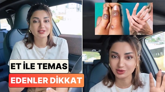 Cildiye Poliklinikleri Bayram Sonrası Doluyor: Bir Doktor Çiğ Et Temasıyla Bulaşan Orf Virüsü'nü Anlattı