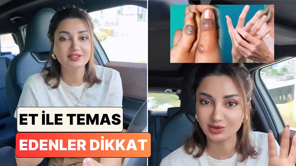 Cildiye Poliklinikleri Bayram Sonrası Doluyor: Bir Doktor Çiğ Et Temasıyla Bulaşan Orf Virüsü'nü Anlattı