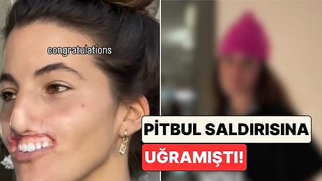 Pitbul Saldırısında Üst Dudağını Tamamen Kaybeden Genç Kadının Ameliyatlarla Yaşadığı Değişimi Paylaştı