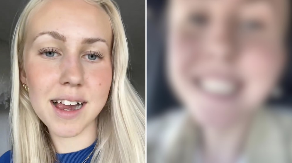 Woman Shares Incredible Transformation of Her Teeth Through Orthodontic Treatment