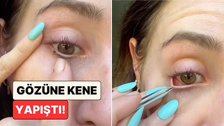 Yaz Geldi Kene Kabusu Başladı: Gözüne Kene Yapışan Kadın Cımbızla Müdahale Ettiği Anları Paylaştı