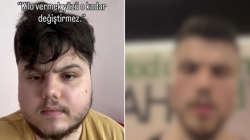 Natural V-Line: Young Man Shares Shocking Face Transformation After Losing Weight
