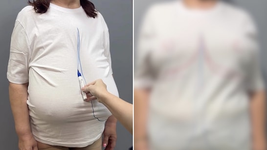 Pure Relief: Woman Shares Shocking Transformation After Breast Reduction Surgery