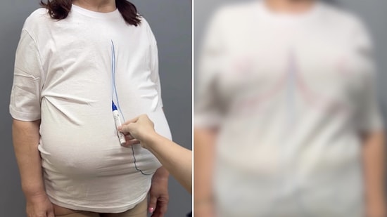 Pure Relief: Woman Shares Shocking Transformation After Breast Reduction Surgery