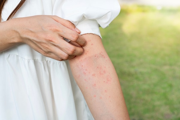 So, what can you do to protect yourself from mosquitoes in the summer?
