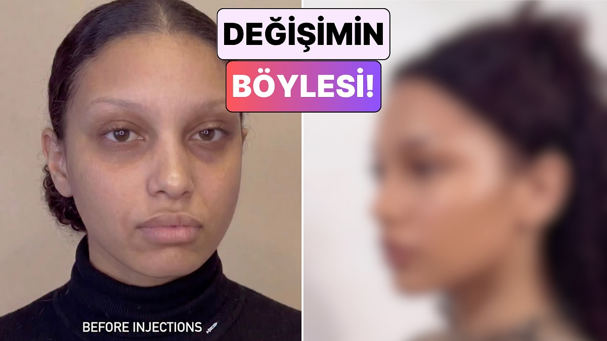 Yüzünün Çeşitli Yerlerine Dolgu Yaptıran Kadının Değişimi Görenleri Hayrete Düşürdü