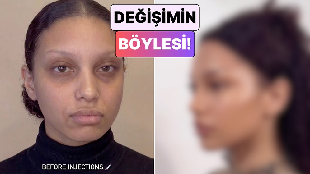 Yüzünün Çeşitli Yerlerine Dolgu Yaptıran Kadının Değişimi Görenleri Hayrete Düşürdü