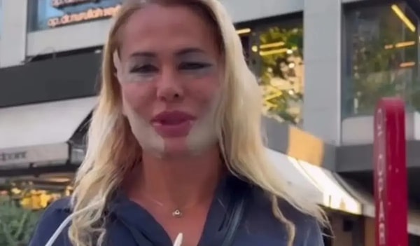 Nagihan Karadere, Survivor'ın ardından ilk iş olarak estetik yaptırdı.