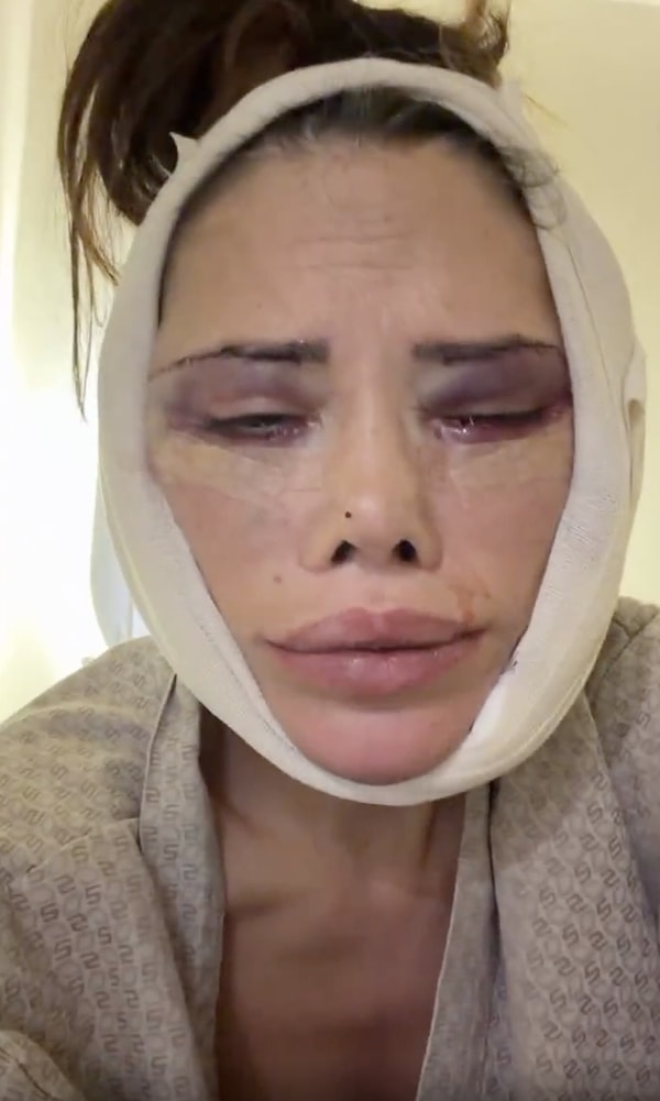 2006 yılında Oryantal Star yarışmasıyla tanınan, 2011 yılında ise Survivor ile geniş kitlelere ulaşan Didem Ceran, estetik operasyonlarıyla yeniden gündemde.