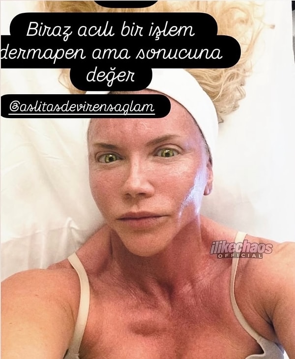 Suden bu kez spor ya da açıklamalarıyla değil, yaptırdığı estetik uygulamayla gündeme geldi.