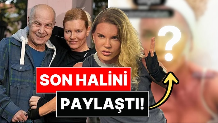 Mazhar Alanson'un Eşi Biricik Suden, Estetik İşlem Sonrası Son Halini Paylaştı!