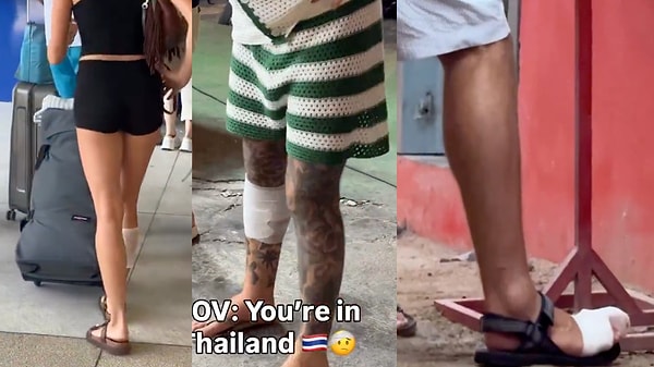 Peki sosyal medyada şaka amaçlı Tayland dövmesi denen bu yanıkların sebebi ne?