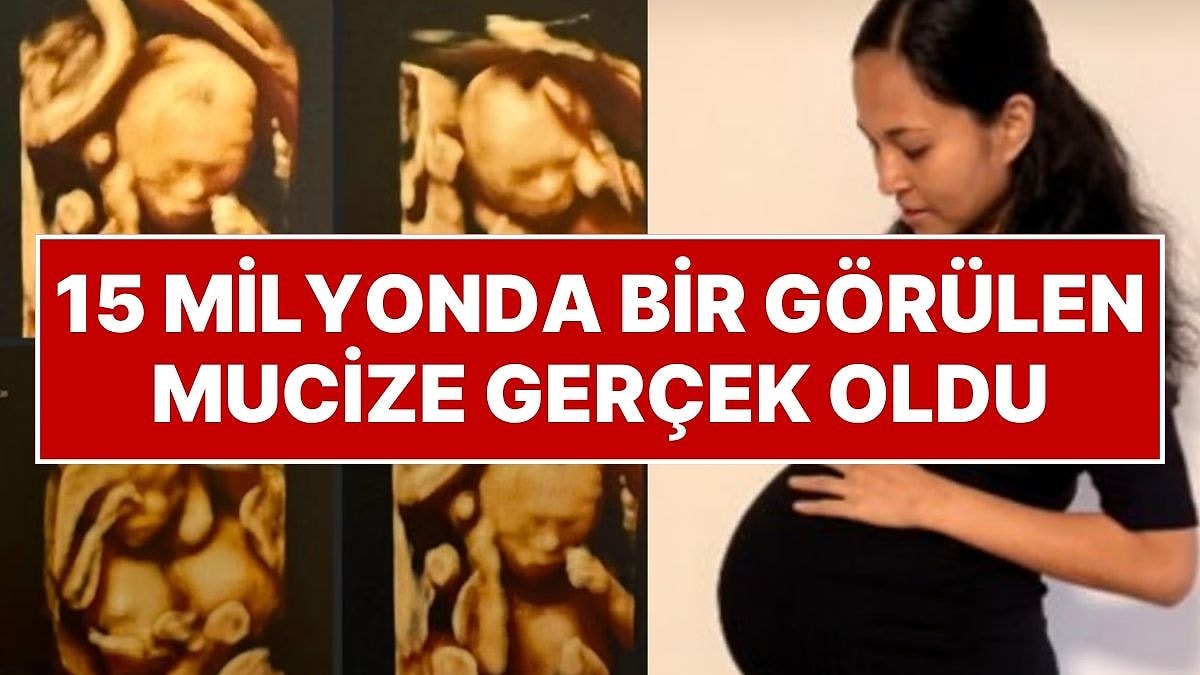 15 Milyonda Bir Görülen Mucize: Tek Plasentada Olan Tek Yumurta Dördüzleri Doğdu