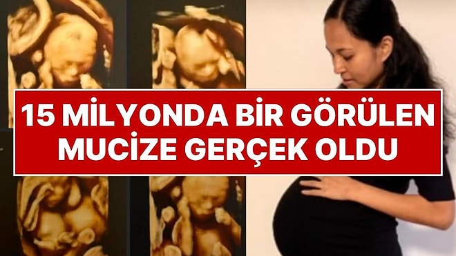 15 Milyonda Bir Görülen Mucize: Tek Plasentada Olan Tek Yumurta Dördüzleri Doğdu