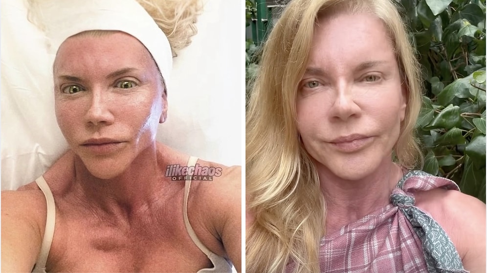 Biricik Suden Fires Back at Cosmetic Surgery Comments With a Blunt Response