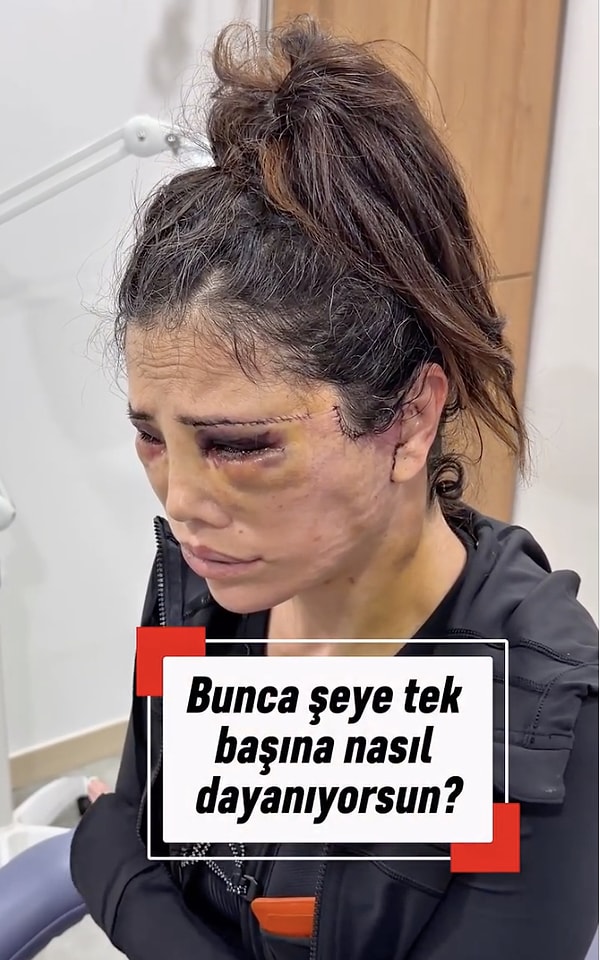Didem Ceran continues to hold her place in the spotlight with her previous statements and a lengthy cosmetic surgery in Korea.