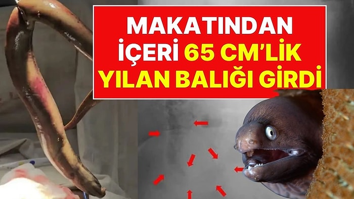 Balık Tutmak İsteyen Adamın Makatından İçeri 65 Santimetrelik Yılan Balığı Girdi, Bağırsağı Parçalandı!