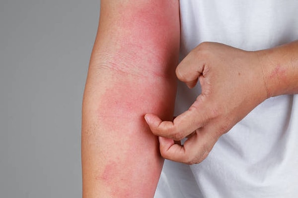 Does It Treat Eczema?