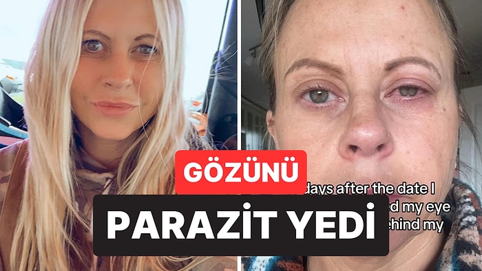 Kontakt Lensiyle Yüzünü Yıkadı, Gözünü Kör Etme Noktasına Getirdi