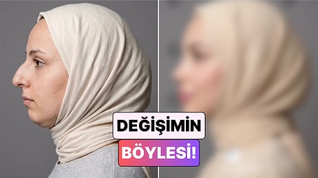 Bambaşka Biri Oldu: Bir Kadın Yaptırdığı Estetiklerle Yaşadığı Değişimi Paylaştı